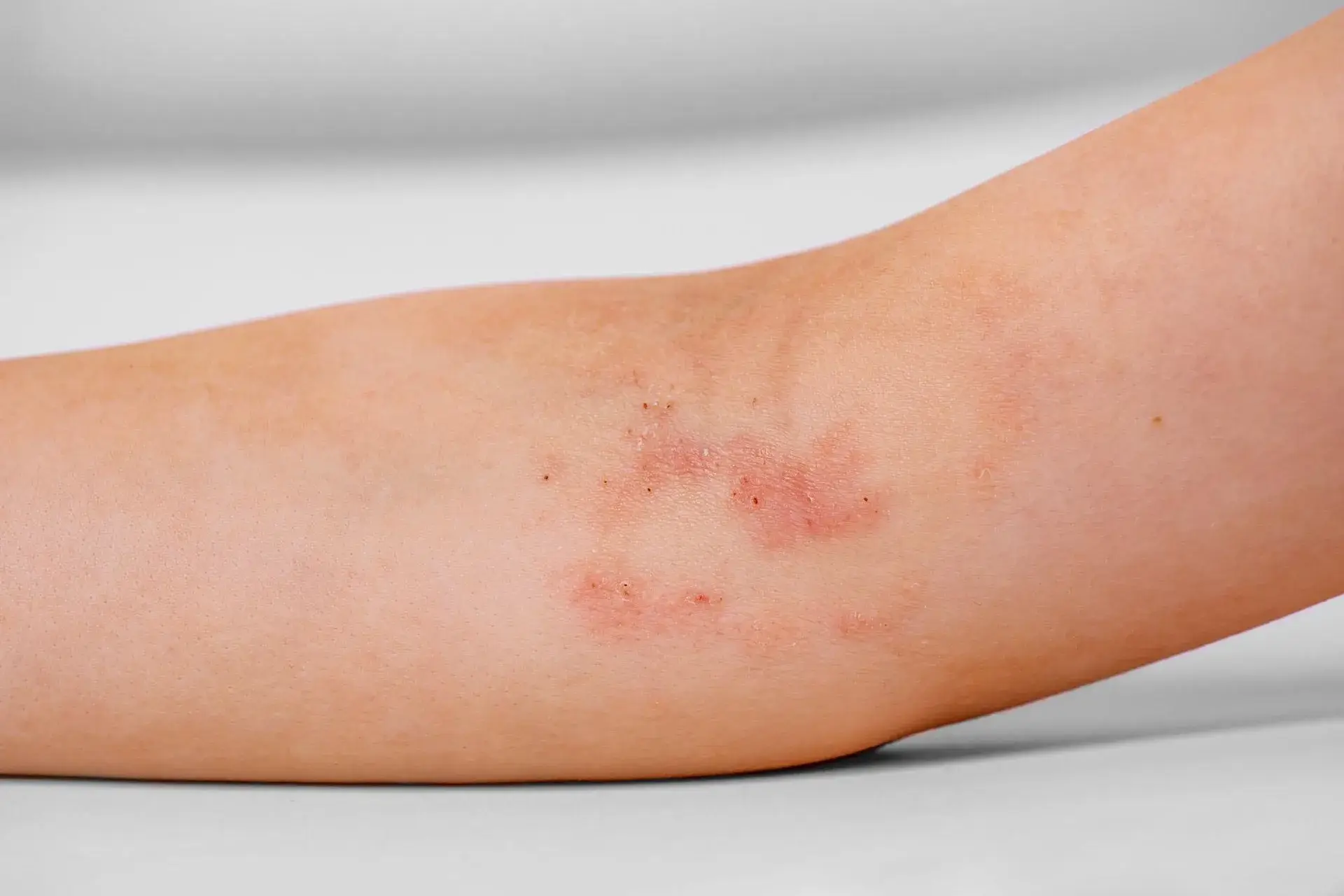 Preclinical laboratory research supporting inflammatory skin disease studies